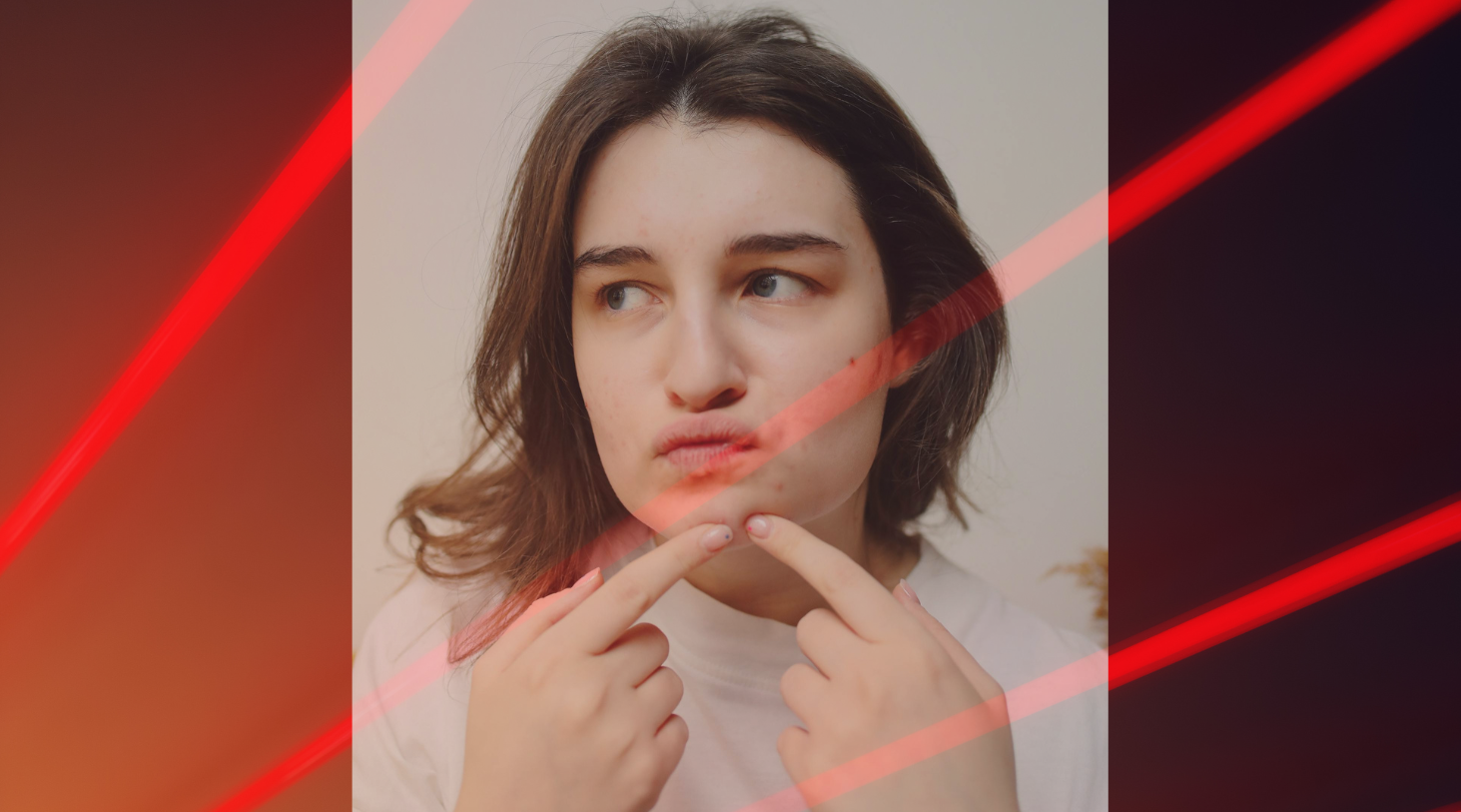 Can red light therapy cause acne